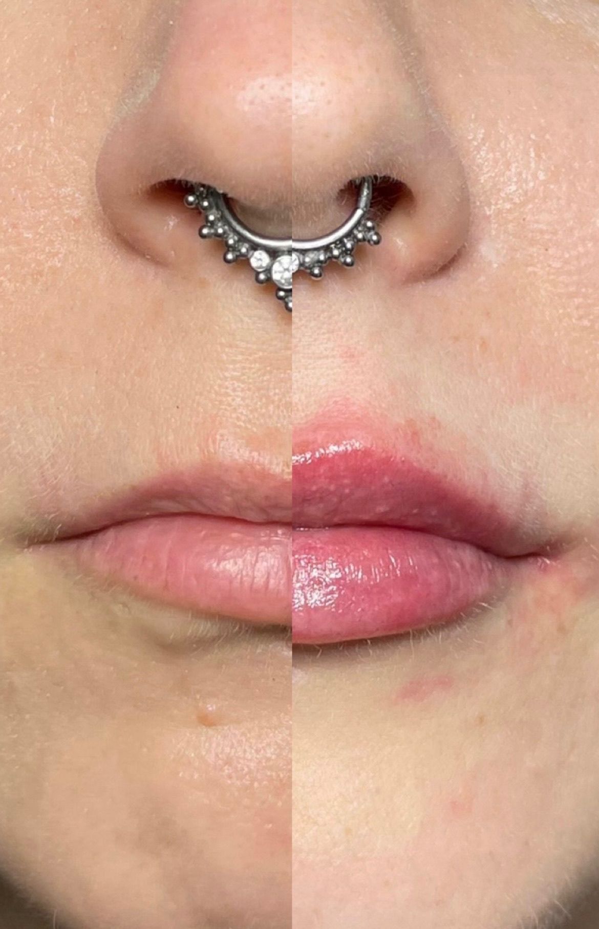 Lip Filler London: Natural Lip Enhancement & Modern Lip Augmentation