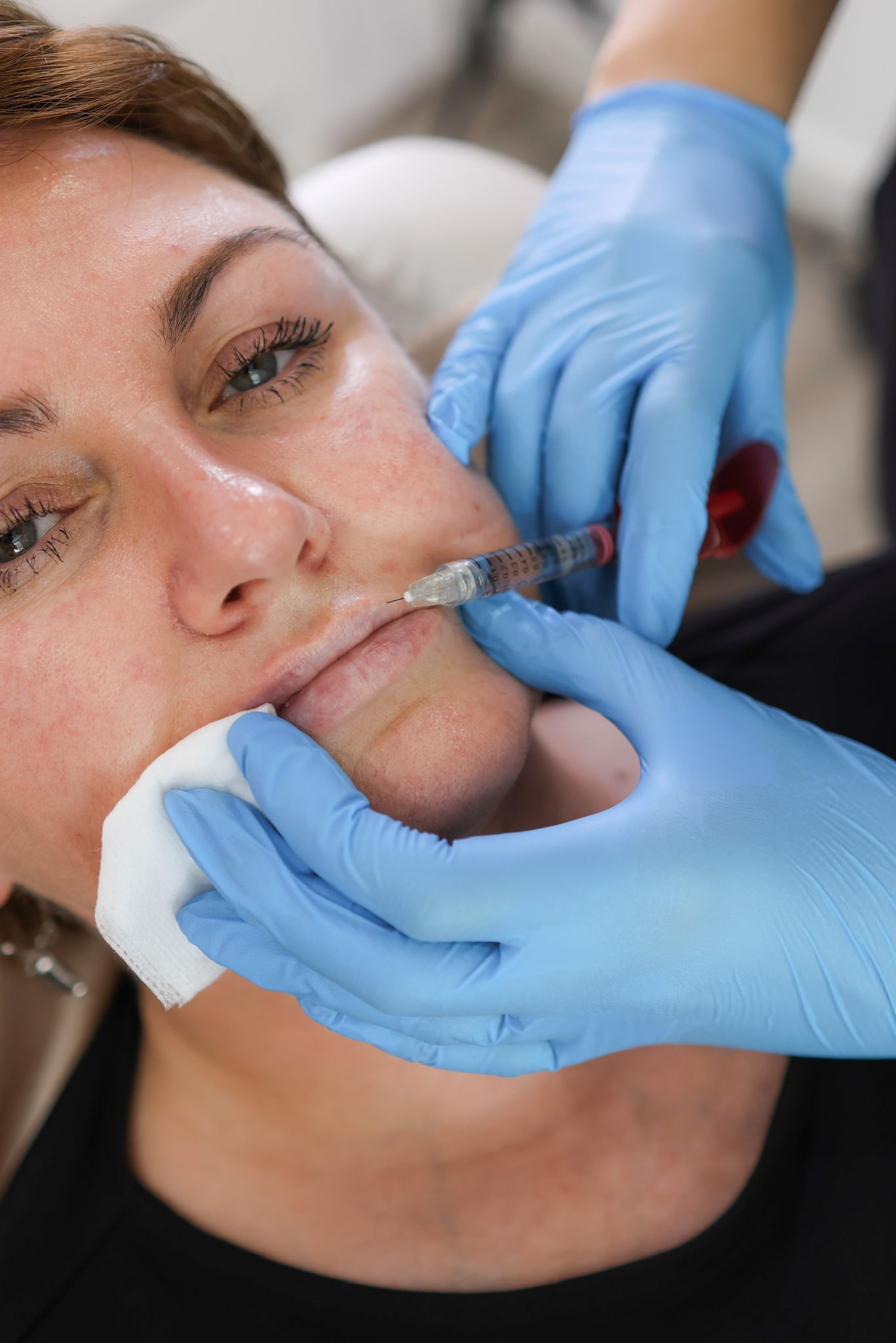 Lip Filler London: Natural Lip Enhancement & Modern Lip Augmentation