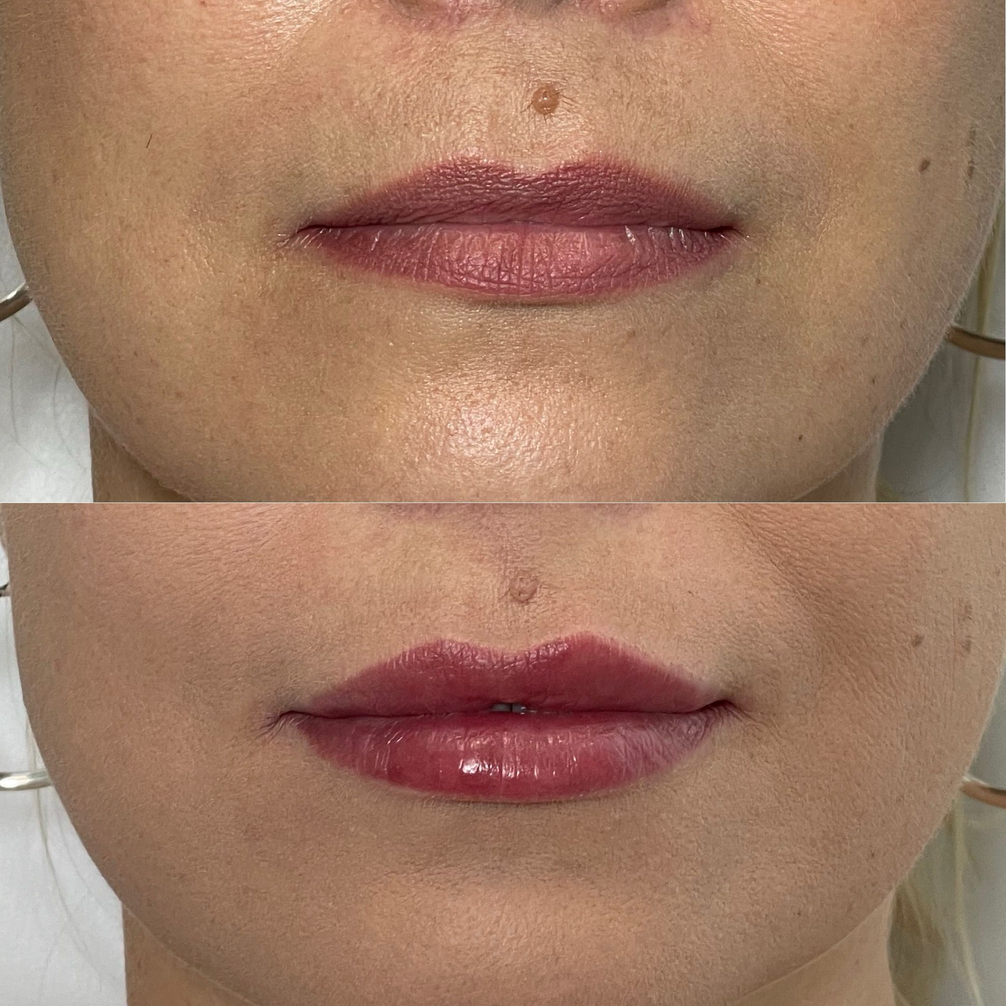 Lip Filler London: Natural Lip Enhancement & Modern Lip Augmentation