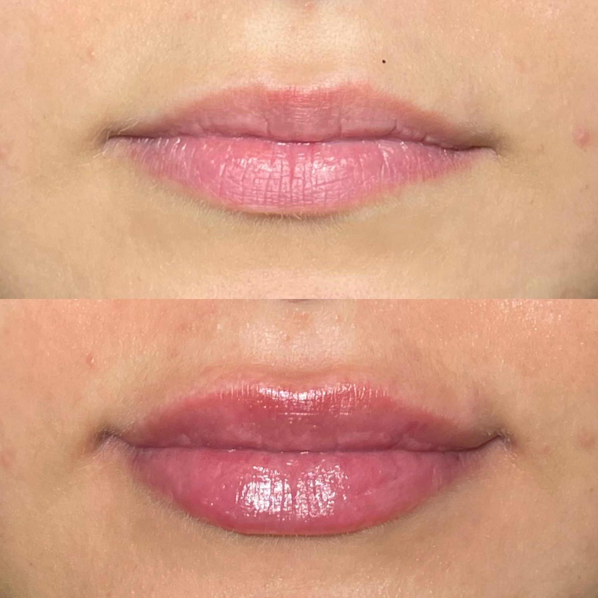 Lip Filler London: Natural Lip Enhancement & Modern Lip Augmentation